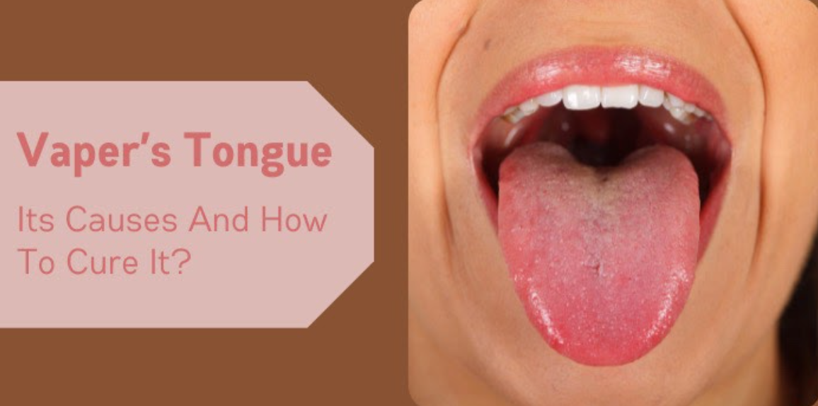 Vaper s Tongue Its Causes And How To Cure It